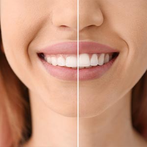 The image shows a side-by-side comparison of a person s face with and without teeth whitening treatment, highlighting the difference in brightness and appearance.